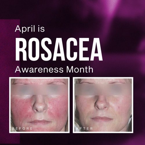 Rosacea Awareness Month social media post showing before and after treatment results for a medical practice